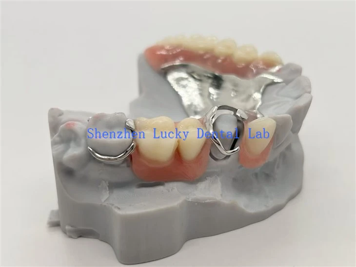 3D-utskrift Dental metall partiell protes