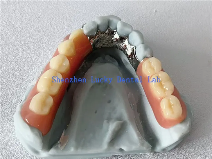 3D Print Lingual Plate Dental Metal Framework with Acrylic Denture
