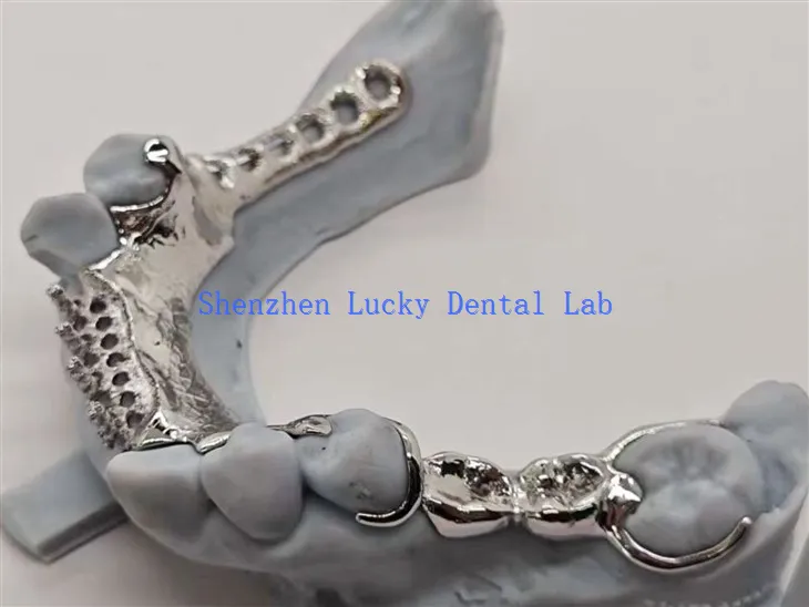 3D Print Metal Framework med legeringstödande tanddesign