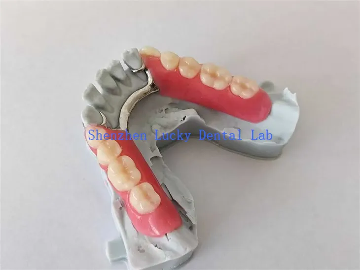 3D -tryck Partiell akrylprotes med metallramförsök i Dental Lab