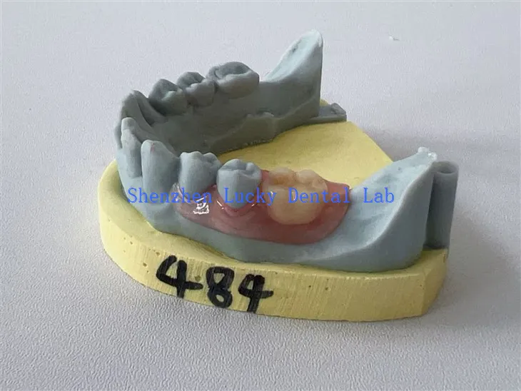 China 3D Print Dental Partial Flexible Denture Factory