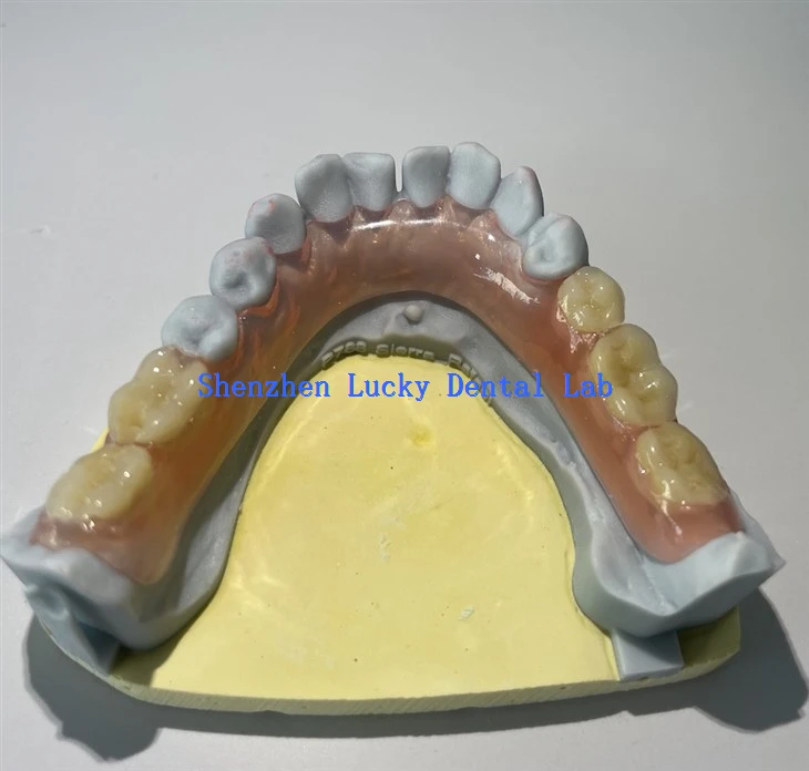 Anpassad 3D -utskrift flexibel tandprotesdentallaboratorium