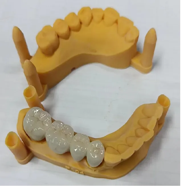 High Quality PFM CoCr Dental Bridge