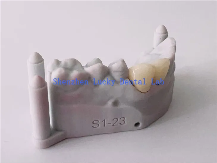Natural 3D Print Dental PFM COCR Bridge Manufacturer