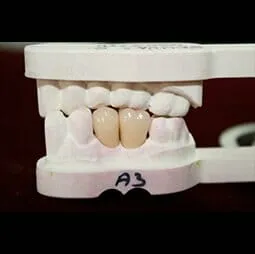 Semi - ädelmetall palladium - silverkrona