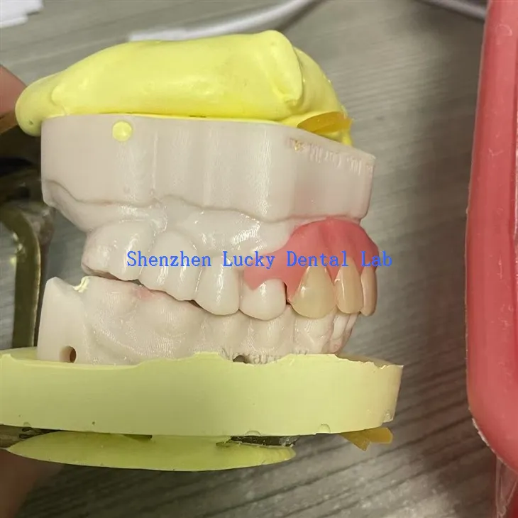 Bekväm partiell flexibel tandprotes i tandlaboratorium