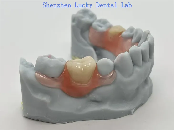 Valplast® -partier med flexibel lås